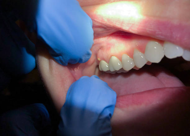 Best Emergency Treatment for Toothache in Stockton, KS